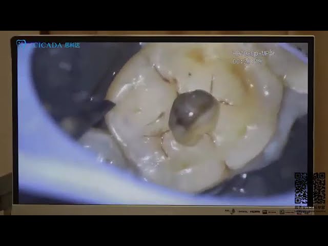Practical Course of Root Canal Therapy by Prof. He WenXi